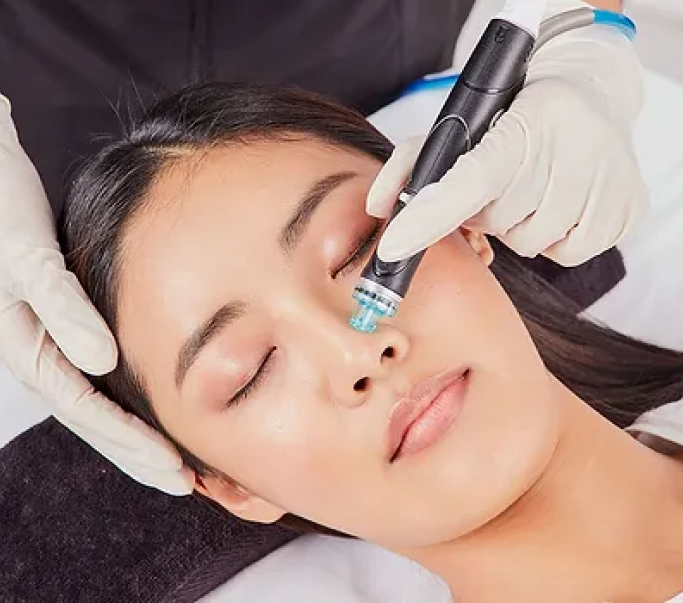 Micro-needling with RF & PRF