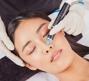 Micro-needling with RF