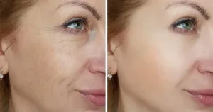 Before and after: Results of Hydrafacial for wrinkles